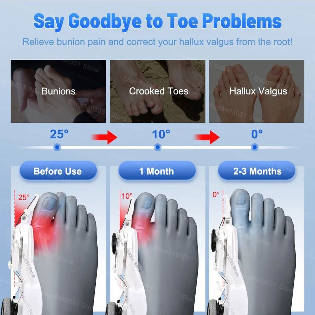 Correcteur Hallux Valgus pour Femme et Homme avec Molette Réglable – مصحح وضعية القدم - الصورة 5